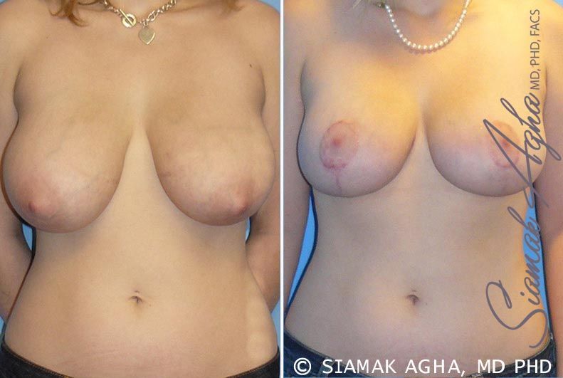 Breast Reduction Before & After