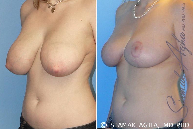 Breast Reduction Before & After