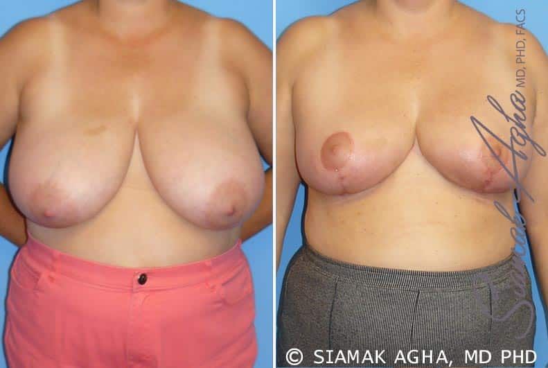Breast Reduction Before & After