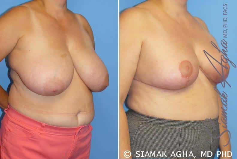 Breast Reduction Before & After