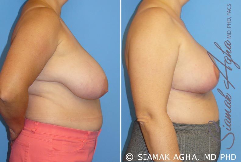 Breast Reduction Before & After