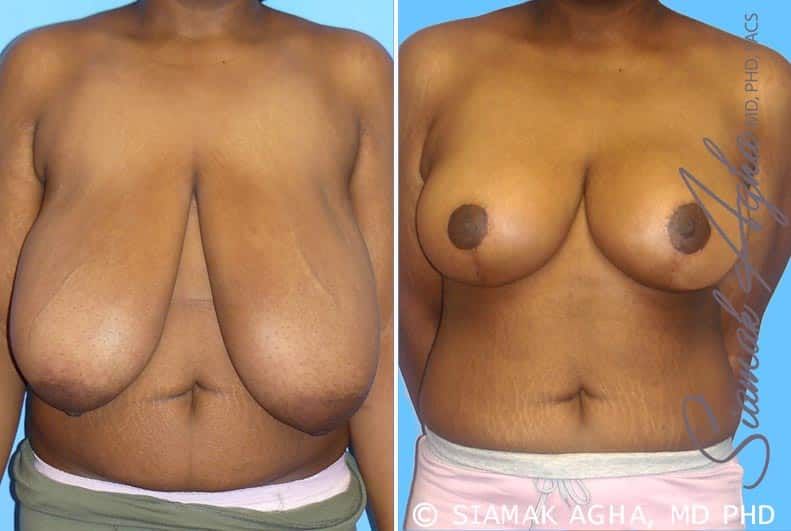 Breast Reduction Before & After