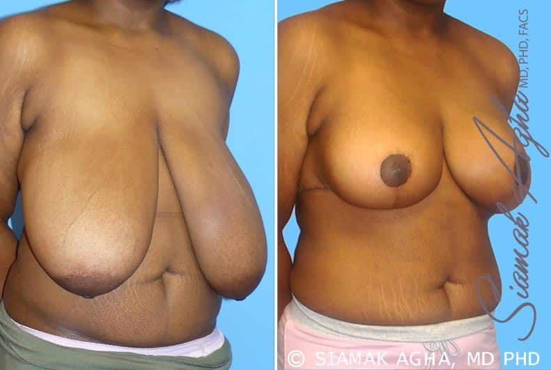 Breast Reduction Before & After
