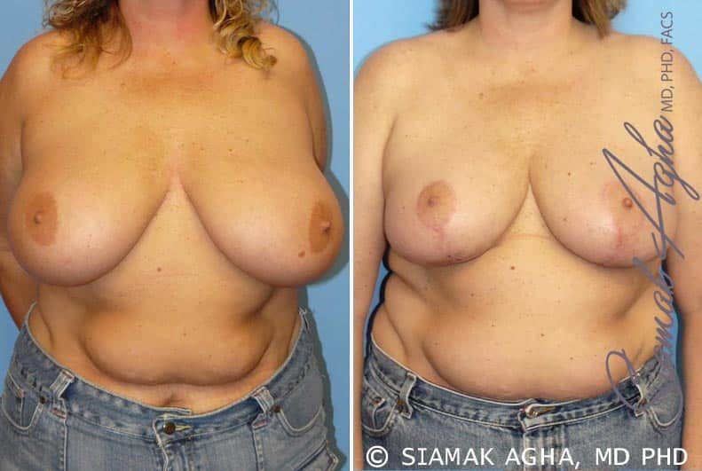 Breast Reduction Before & After