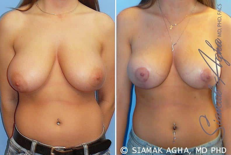 Breast Reduction Before & After