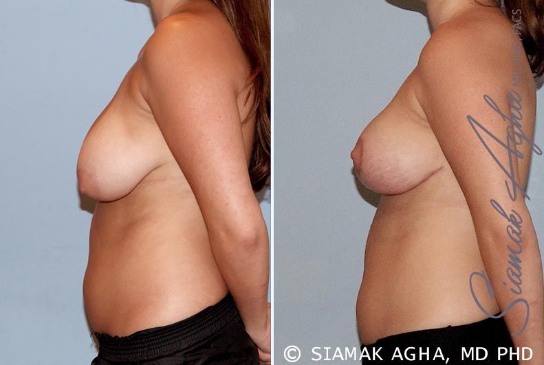 Breast Reduction Before & After