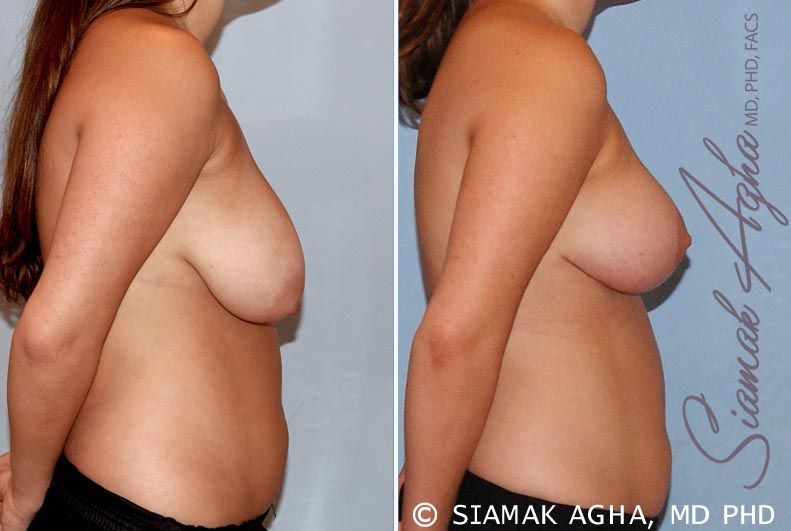 Breast Reduction Before & After