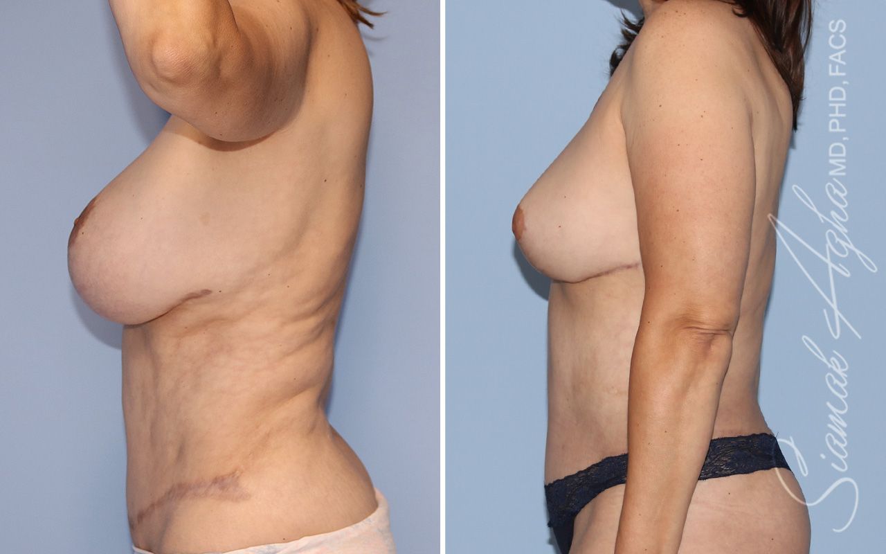Breast Reduction Before & After