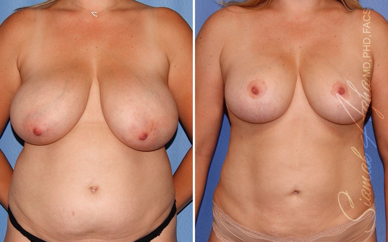Breast Reduction Before & After