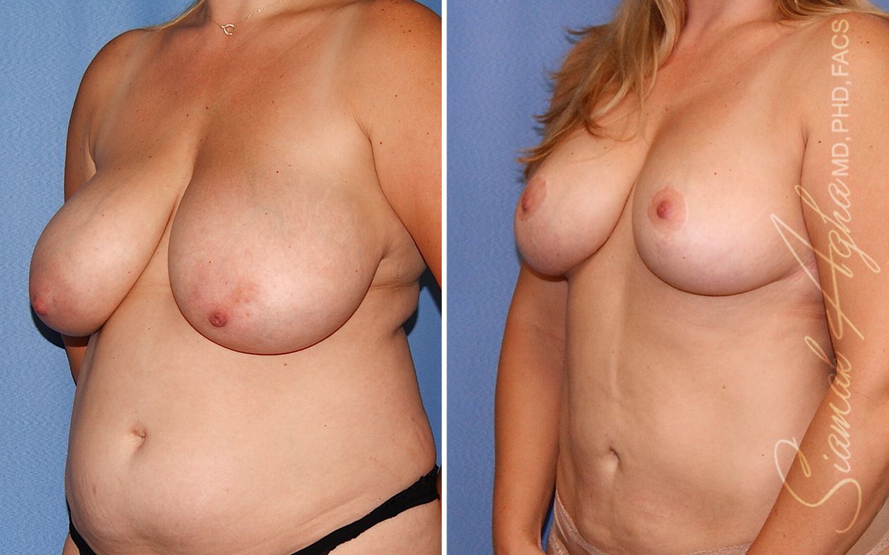 Breast Reduction Before & After