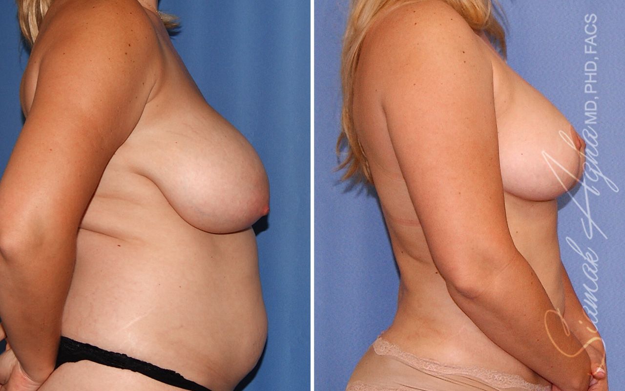 Breast Reduction Before & After