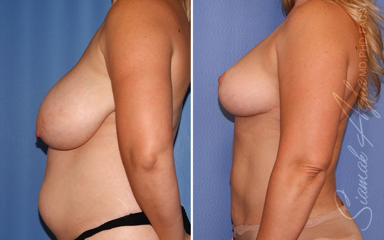 Breast Reduction Before & After