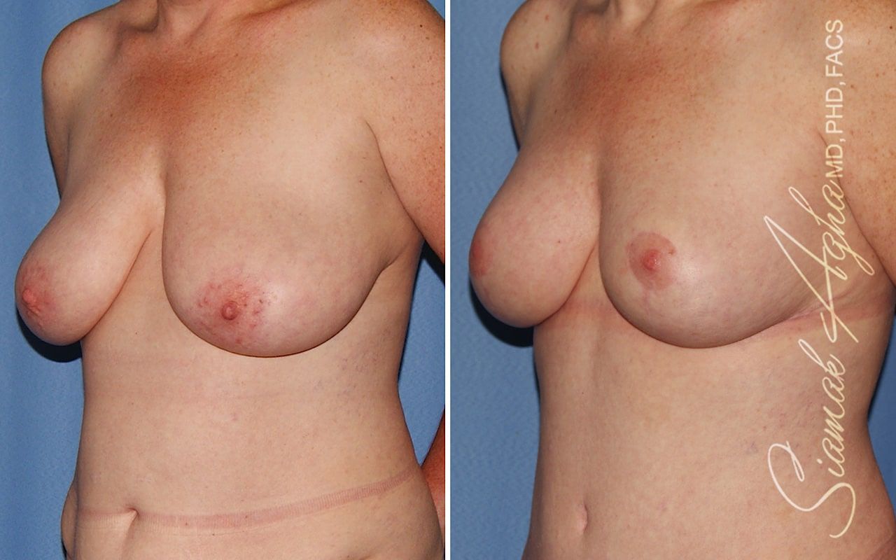 Breast Reduction Before & After