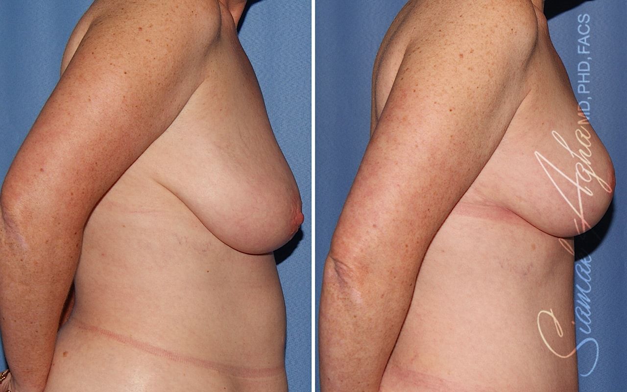 Breast Reduction Before & After