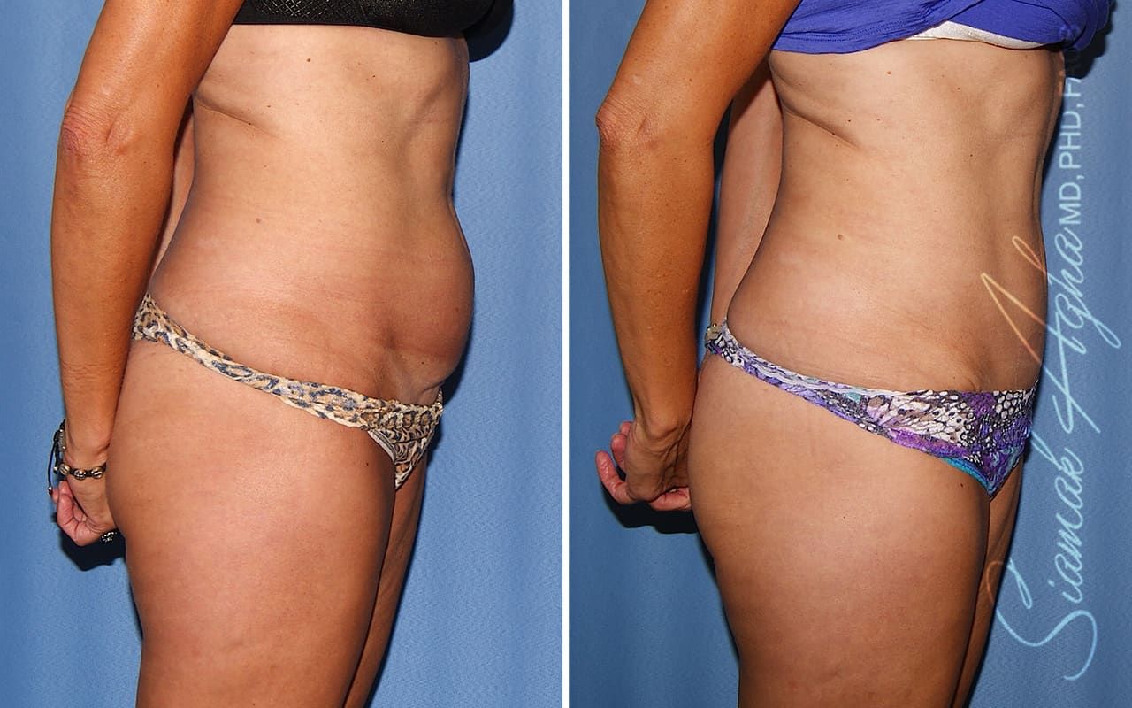 Mini Tummy Tuck Before & After