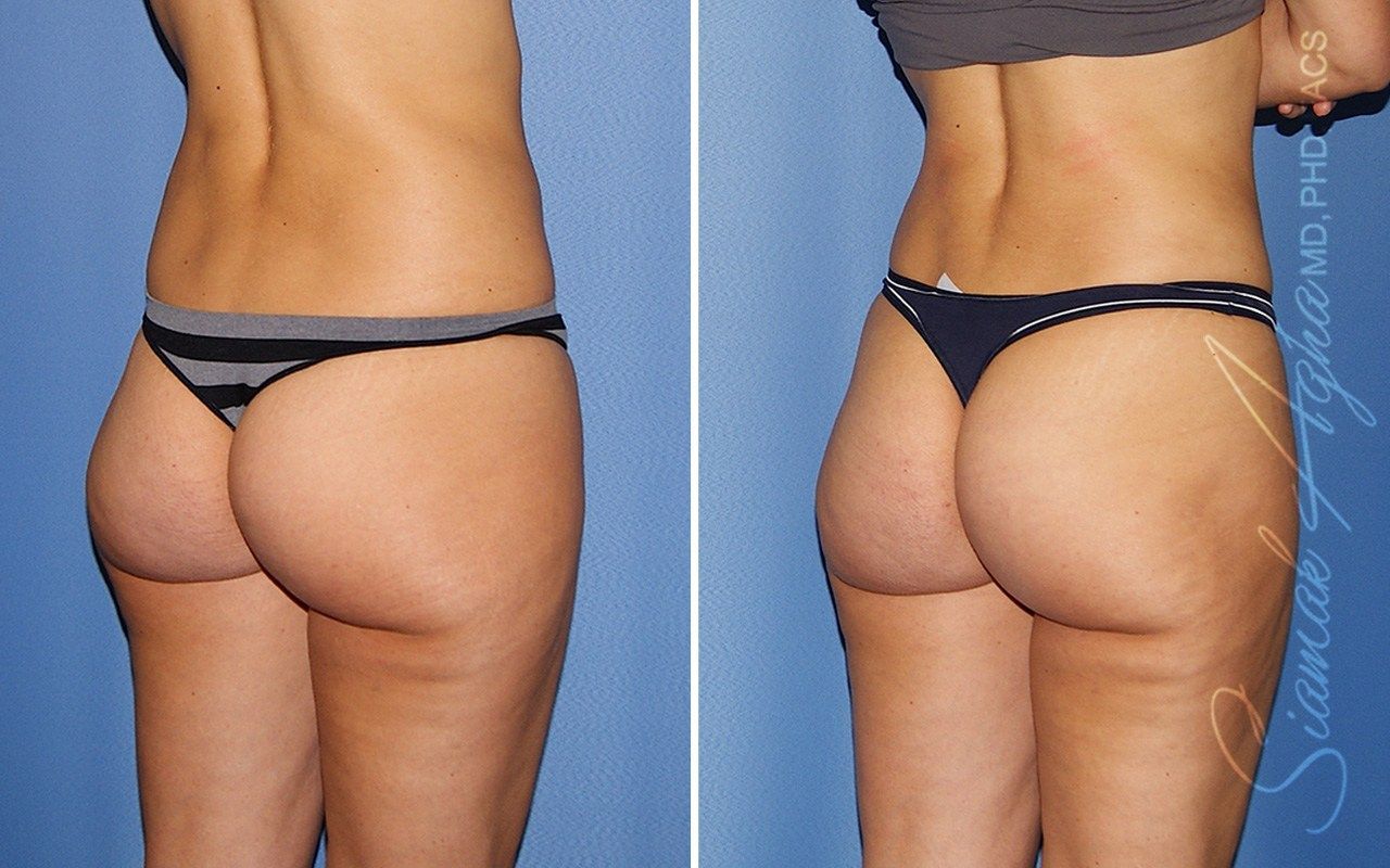 Mini Tummy Tuck Before & After