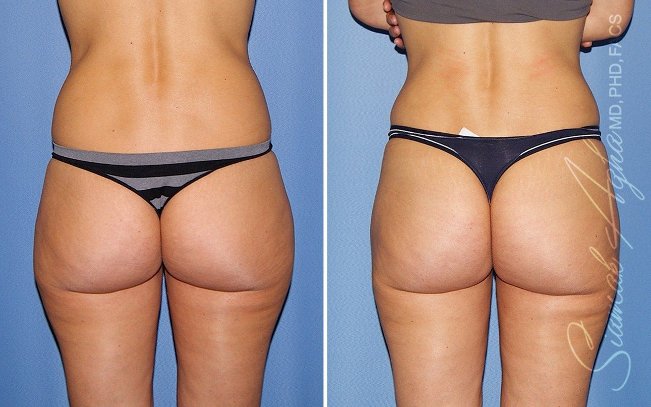 Mini Tummy Tuck Before & After