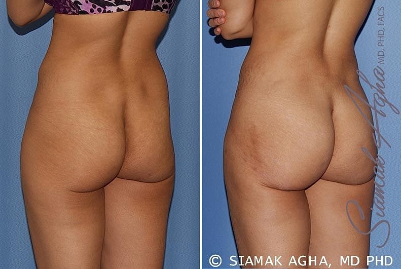 Before and after body contouring procedure comparison
