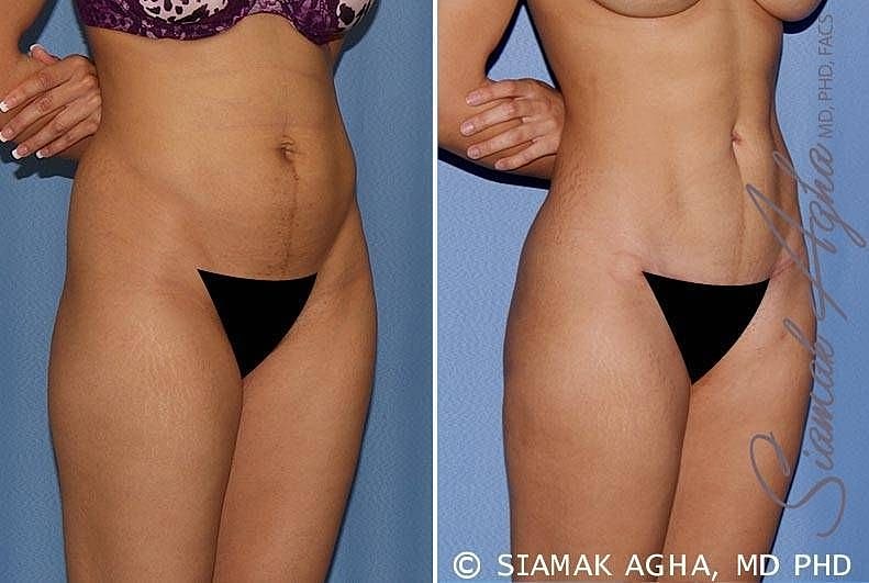 Before and after body contouring treatment.
