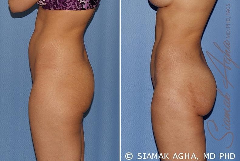 Before and after body contouring transformation comparison