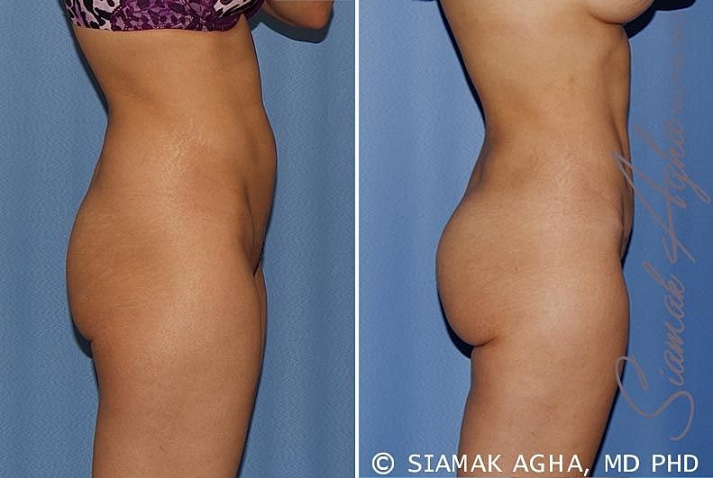 Side profile before and after body contouring.