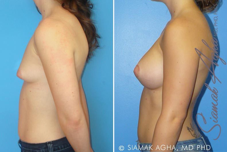 Tubular Breast Correction Before & After