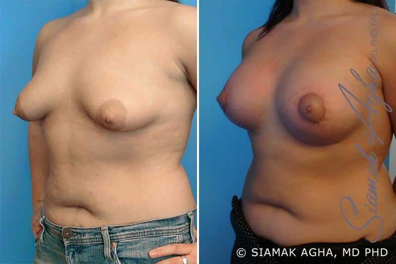 Tubular Breast Correction Before & After