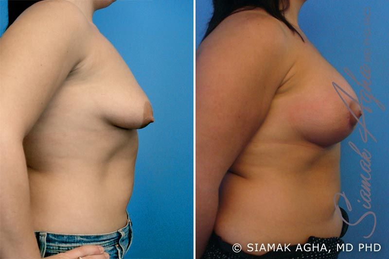 Tubular Breast Correction Before & After