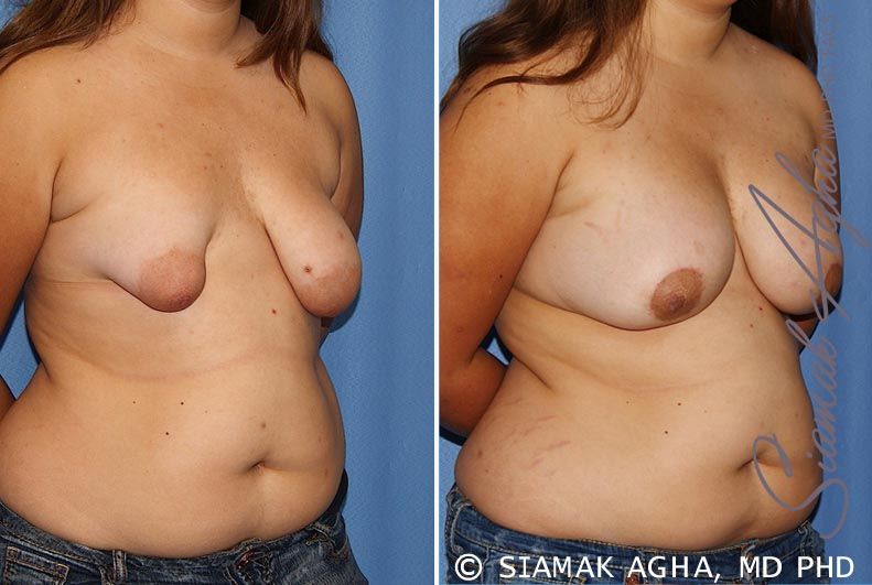 Tubular Breast Correction Before & After