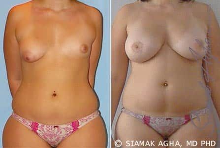 Tubular Breast Correction Before & After