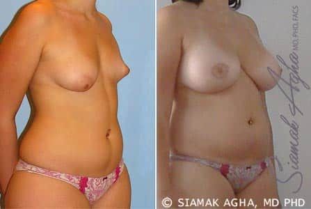 Tubular Breast Correction Before & After