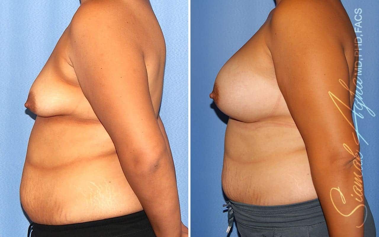 Tubular Breast Correction Before & After