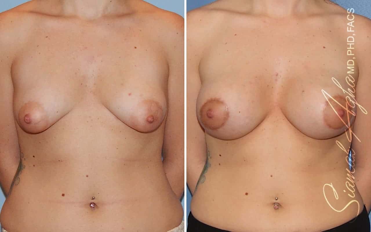 Tubular Breast Correction Before & After
