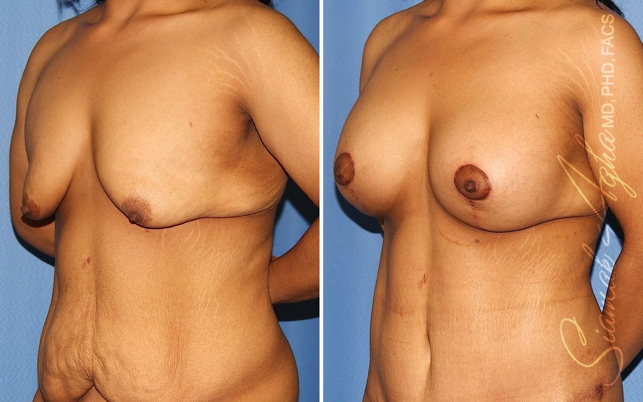 Tubular Breast Correction Before & After