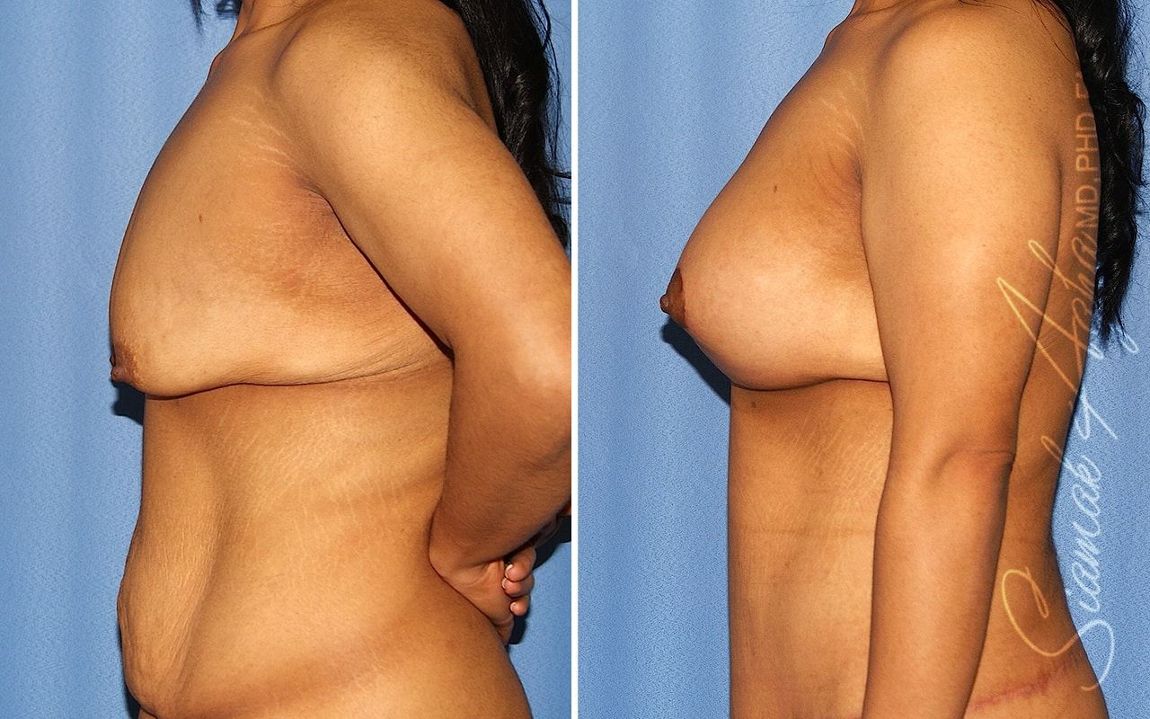 Tubular Breast Correction Before & After