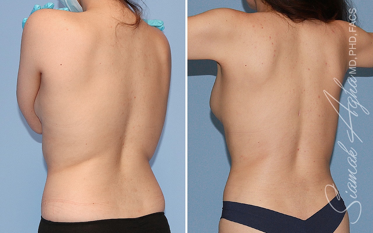 Tubular Breast Correction Before & After