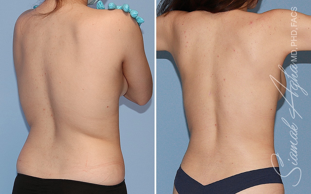 Tubular Breast Correction Before & After