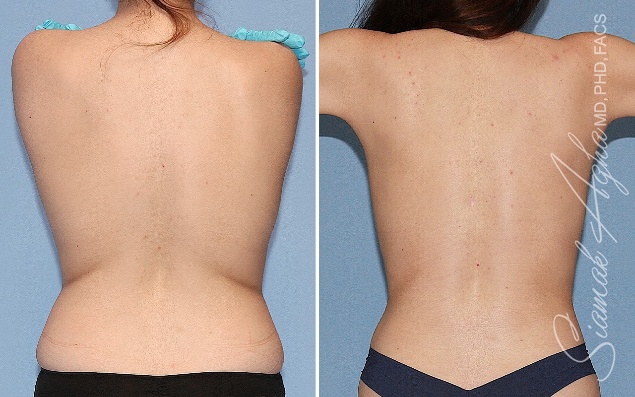 Tubular Breast Correction Before & After