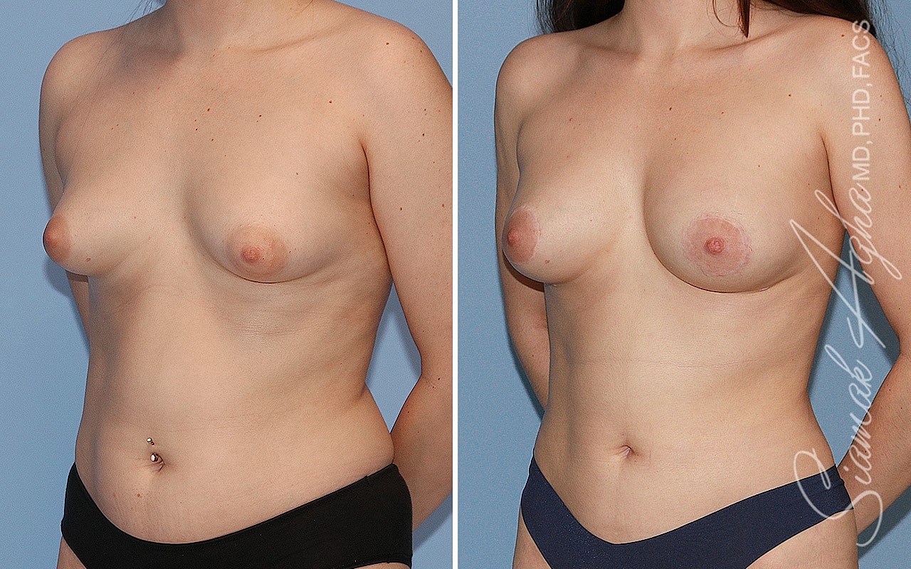 Tubular Breast Correction Before & After