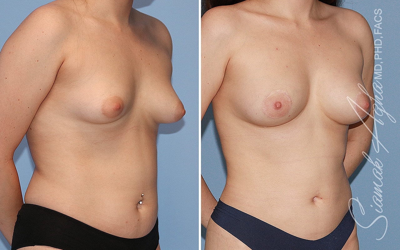 Tubular Breast Correction Before & After