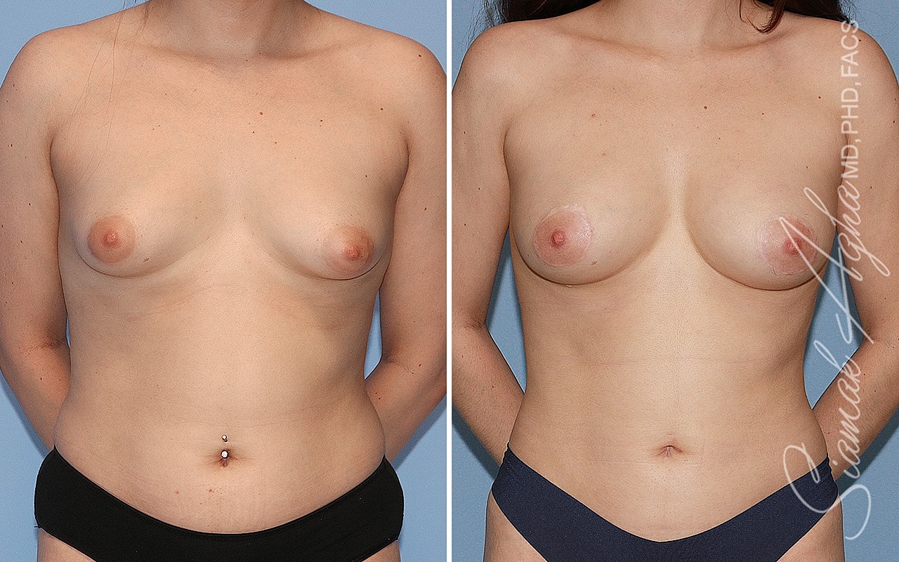 Tubular Breast Correction Before & After