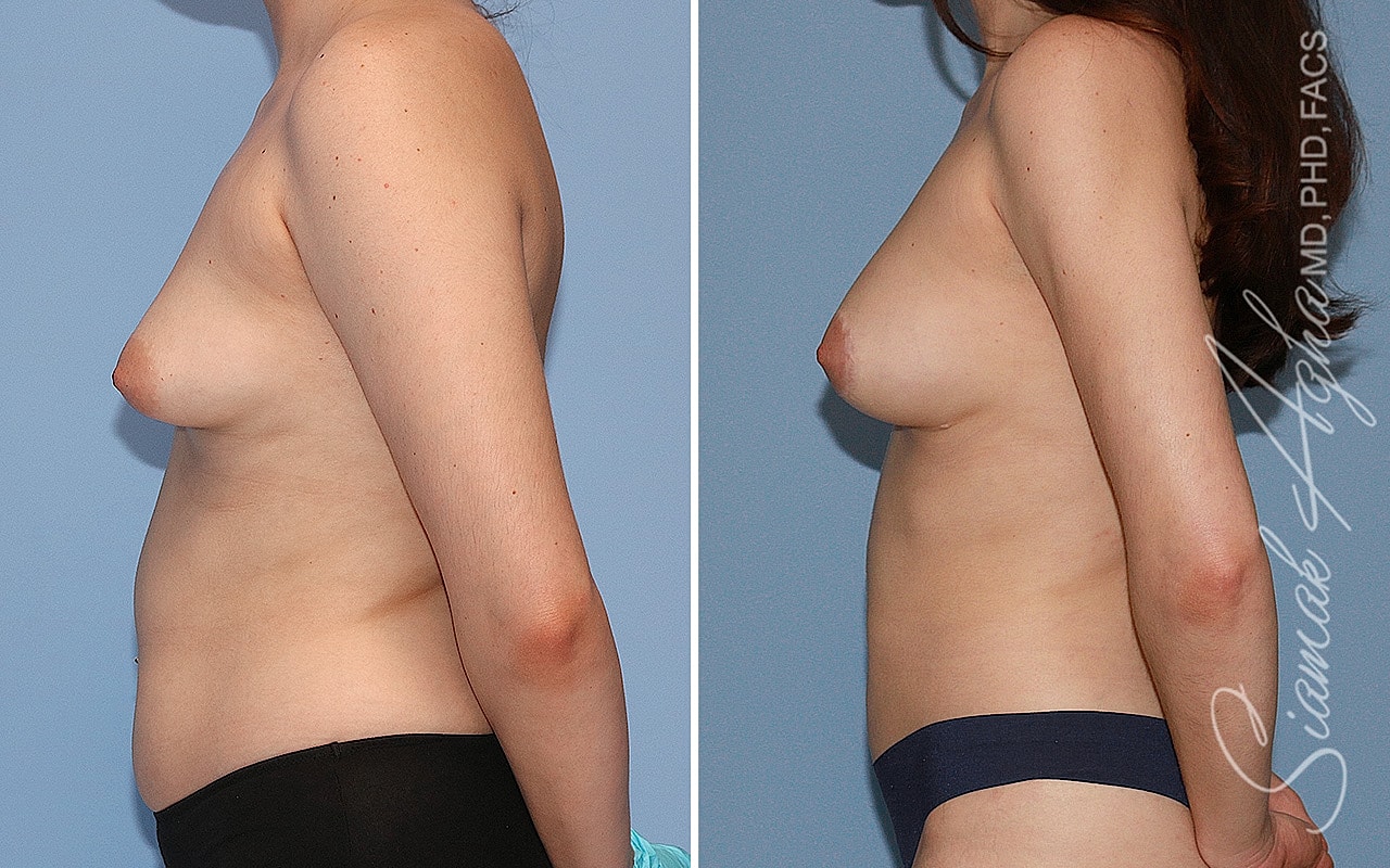 Tubular Breast Correction Before & After