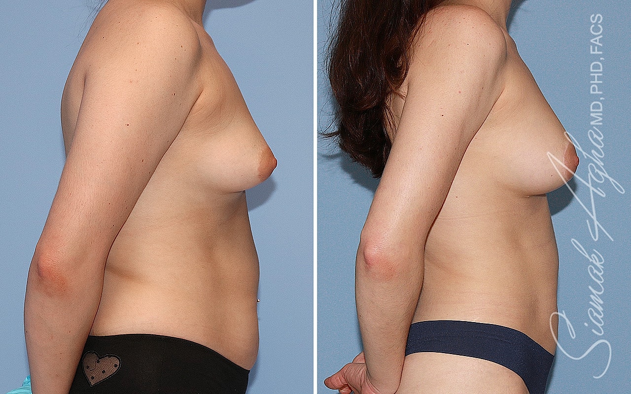 Tubular Breast Correction Before & After