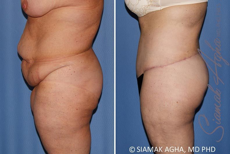 Lower Body Lift Before & After