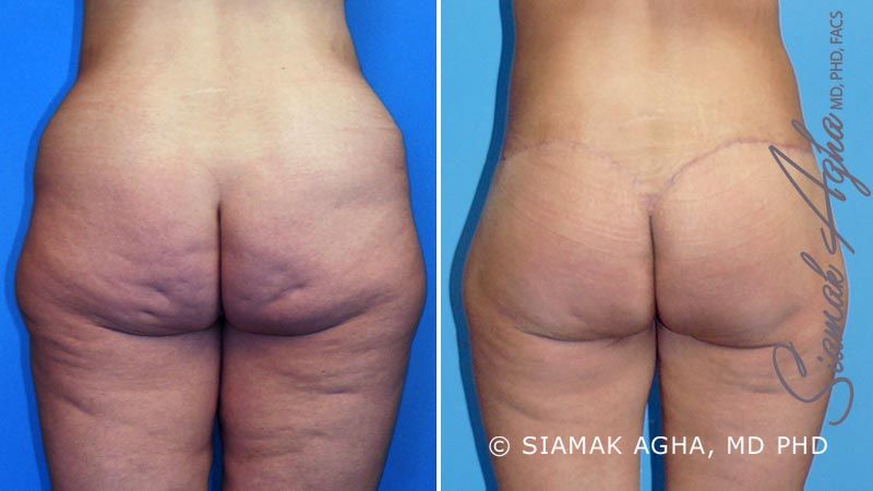 Lower Body Lift Before & After