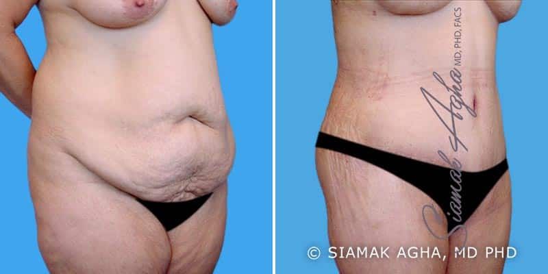 Lower Body Lift Before & After