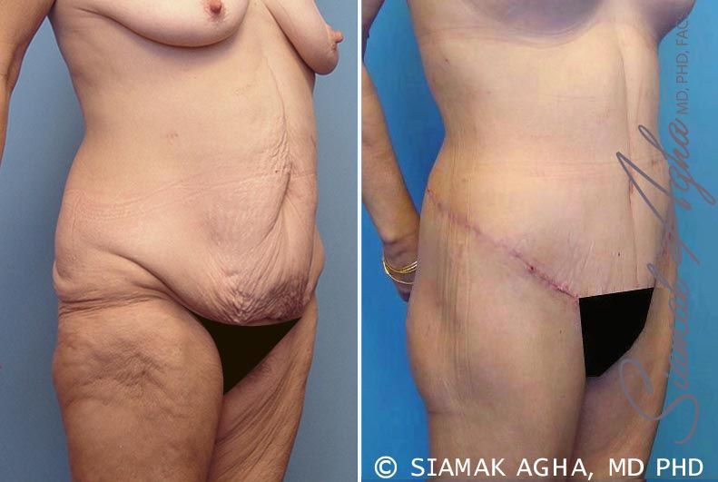 Lower Body Lift Before & After