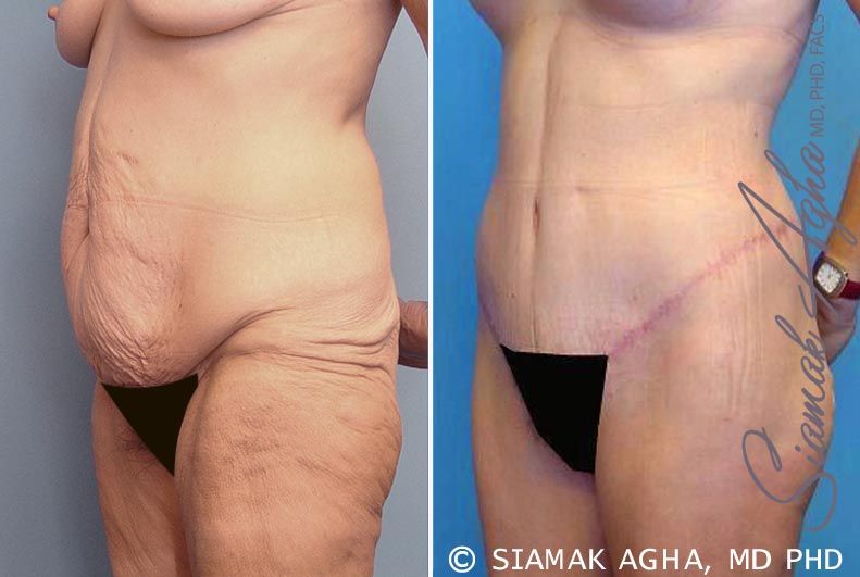 Lower Body Lift Before & After