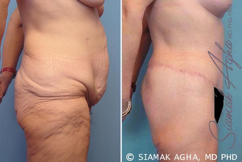 Lower Body Lift Before & After