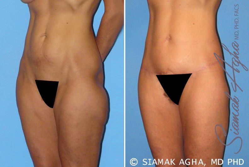 Lower Body Lift Before & After